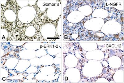 Correlations Between the Expression of Stromal Cell Activation Related Biomarkers, L-NGFR, Phospho-ERK1-2 and CXCL12, and Primary Myelofibrosis Progression